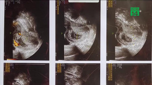 Sáng nói không có thai, chiều nói sảy thai: Bệnh viện thị uy, đối đầu bệnh nhân gây bức xúc