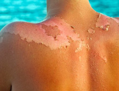 Tại sao da lại bong tróc khi bị 'tra tấn' cả ngày dưới nắng?