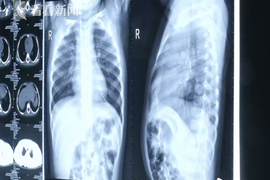 Kim khâu đâm vào tim bé gái đến khi han rỉ, bố mẹ vẫn không hề hay biết