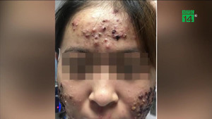 Clip: Cô gái 20 tuổi nổi mụn trứng cá sần sùi từng mảng như cơm cháy