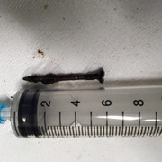 Bị cây đinh gỉ sét văng vào phổi, người đàn ông nghèo nhịn đến bệnh viện suốt 4 tháng