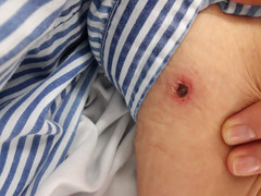 Từ một vết bọ đốt ở tay, người phụ nữ suýt mất mạng