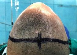 7 giờ căng thẳng phẫu thuật cho bé trai 20 tháng có đầu biến dạng thành hình tam giác