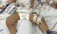 Cứu sống bé trai có 8 lỗ thủng ở ruột