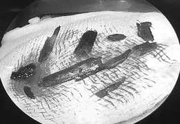 Ngã xe đập mặt xuống đường, người đàn ông bị 10 mảnh gỗ găm vào hốc mắt