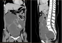 Người phụ nữ 35 tuổi mang khối u 2,8kg hiếm gặp