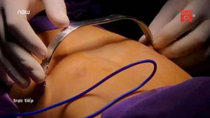 Trả lại ngực phẳng cho 2 trẻ bị lõm ngực nặng ở Quảng Ninh