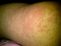 Chàng trai ở TP.HCM mắc căn bệnh hơn triệu người mới có một người gặp phải