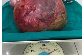 Bệnh viện Đa khoa Đồng Văn - Hà Giang phẫu thuật thành công u nang nặng 5kg