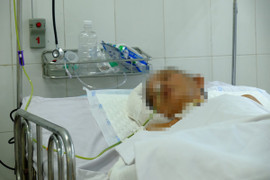 Vợ dùng dầu hôi đốt chồng bỏng da toàn thân