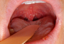 Cảnh báo những người dễ mắc và chết vì ung thư vòm họng