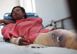 Bình gas mini phát nổ, nữ công nhân 18 tuổi bị bỏng nặng