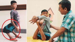 Mắc chứng bệnh quái ác, cậu bé có khớp chân bẻ ngược như chim hồng hạc