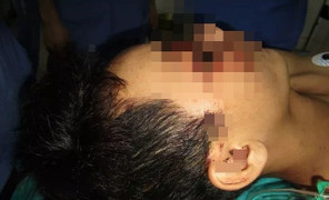 Hoảng hồn nam thanh niên bị lưỡi cưa cắm vào giữa mặt