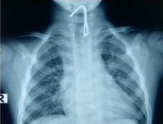 Nuốt móc sắt, bé trai 26 tháng tuổi thủng thực quản