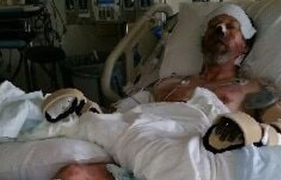 Bị chó liếm, người đàn ông phải cưa cả chân và tay