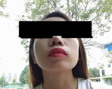 Bỏ 30 triệu đồng phẫu thuật thẩm mỹ, cô gái đau đớn bị lệch mũi