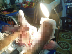 Mâu thuẫn tại quán karaoke, thanh niên bị chém đứt lìa bàn chân