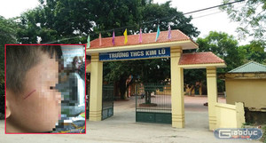 Học sinh ở Hà Nội bị thầy giáo lên gối, tát xước mặt