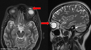 Mất kính áp tròng, 28 năm sau tìm thấy trong mí mắt
