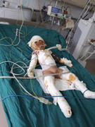 Thảm cảnh gia đình 3 người: Con hôn mê, mẹ bất tỉnh, bố bỏng tuột da chân do can xăng phát nổ