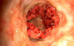 Mỗi năm có khoảng 500.000 người chết vì ung thư đại trực tràng