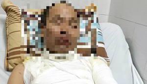 Cha bị tạt axit trước mặt con gái 9 tuổi ở Hà Nội