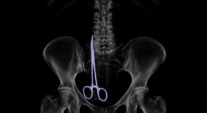 Bác sĩ để quên kéo dài 16cm trong cơ thể bệnh nhân suốt nửa năm