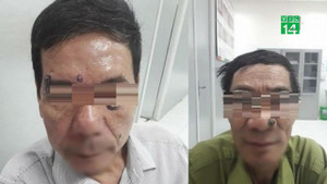 Phát hiện ung thư khi tẩy nốt ruồi: Những dấu hiệu nhất định phải biết