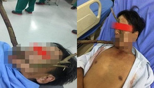 Hy hữu: Người đàn ông ngã xe, bị cành cây đâm thẳng vào miệng