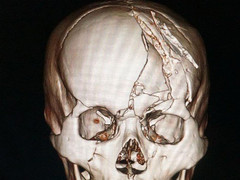 Bị tai nạn lún xương trán, người đàn ông nguy kịch