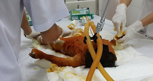 Đốt lá chuối gây cháy nhà, bé gái 20 tháng tuổi bị bỏng 90% cơ thể