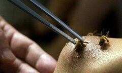 Bác sĩ bật báo động đỏ, cứu sống mẹ con sản phụ sốc phản vệ do ong đốt
