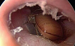 Giật mình con gián béo múp chui rúc, làm tổ trong tai người phụ nữ