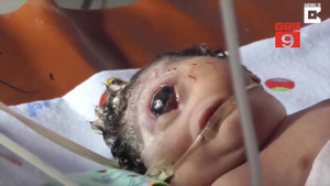 Bố mẹ đau đớn tột độ khi con chào đời chỉ có 1 mắt giữa trán