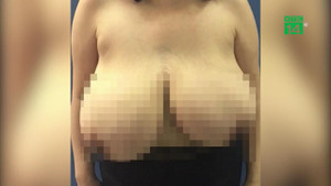 Ngực trái to gấp 5 lần ngực phải, người phụ nữ khốn khổ ngủ nghiêng