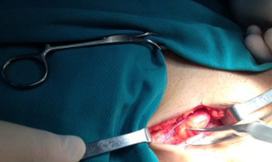 Phẫu thuật điều trị thoát vị bẹn nghẹt cho cụ ông 101 tuổi ở Cần Thơ