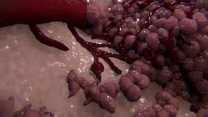 2018, Việt Nam đang ở đâu trên bản đồ ung thư thế giới?