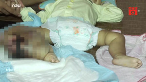 Mẹ khóc nghẹn nhìn con 14 tháng tuổi bị khối u quái ác hành hạ