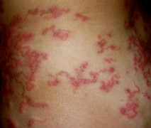 Thường xuyên trồng hoa, người phụ nữ bị nhiễm giun lươn