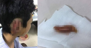 'Ngáo' cỏ Mỹ, thiếu niên cắn lìa tai bạn rồi nuốt vào bụng