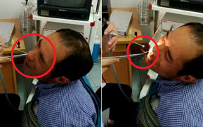 Rùng mình clip gắp con đỉa sống ngoe nguẩy ra khỏi mũi người đàn ông