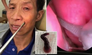 Clip: Đỉa hút máu trú ngụ trong mũi người đàn ông Điện Biên