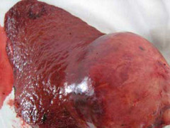 Ung thư gan cướp nhiều sinh mạng người Việt nhất trong các loại ung thư