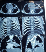 Que xiên thịt nướng găm vào ngực cháu bé 5 tuổi suốt 8 tháng