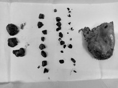 Cứu sống người đàn ông ngoại quốc mang túi mật chứa gần 50 viên sỏi