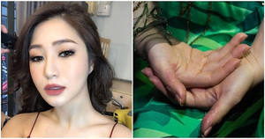 Hương Tràm tự bóc da tay rỉ máu: Bác sỹ cảnh báo hội chứng nguy hiểm chết người
