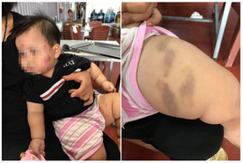 Phụ huynh tố trẻ 11 tháng tuổi bị cắn khắp mặt ở lớp mầm non