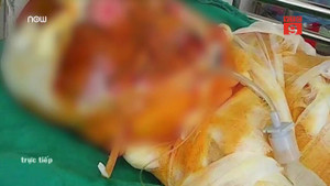 Chồng nướng mực gây cháy, vợ bỏng nặng, con 2 tuổi chết thương tâm