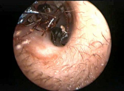 Video: Kiến ngang nhiên tung hoành trong màng nhĩ bé gái 10 tuổi ở Phú Thọ